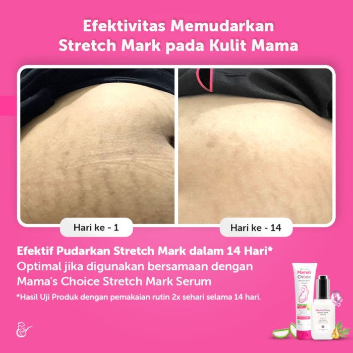 Mama's Choice Stretch Mark Cream